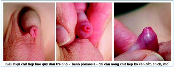 trước và sau nong chít hẹp quy quy đầu hình ảnh trước và sau nong chít hẹp quy quy đầu