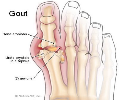 Bệnh Gout là gì? Bệnh Gout là gì?