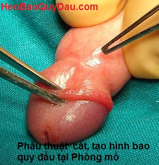 Nong chít hẹp bao quy đầu trẻ nhỏ tránh tái phát hep_bao_quy_dau_7