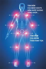 Một số hội chứng do viêm khớp