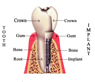 VÌ SAO CẦN CẮM GHÉP IMPLANT? VÌ SAO CẦN CẮM GHÉP IMPLANT?