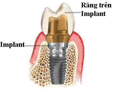 Implant là gì? Implant là gì?